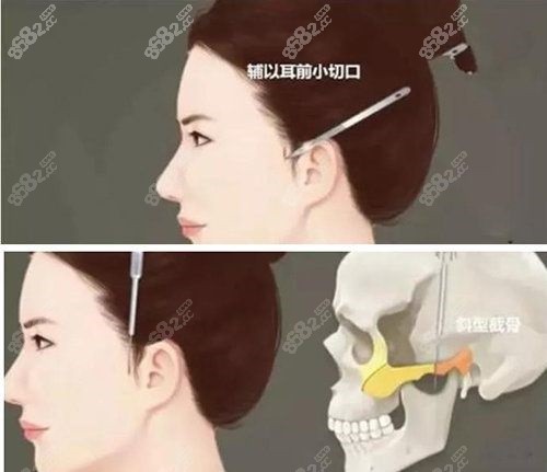重庆星荣刘正茂颧骨内推的手术优势