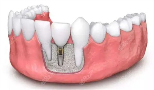 佛山春芽口腔种植牙怎么样