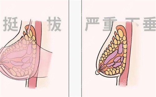 假体隆胸手术【   】期