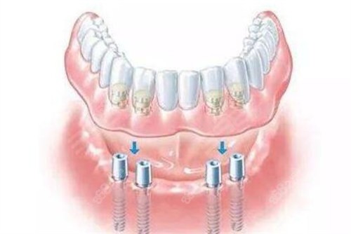 鼎植口腔医院半口种植牙价格表：