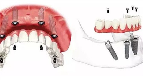 鼎植口腔医院全口种植牙价格表：