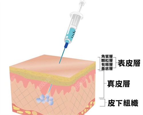 周俐君院长招注射模特