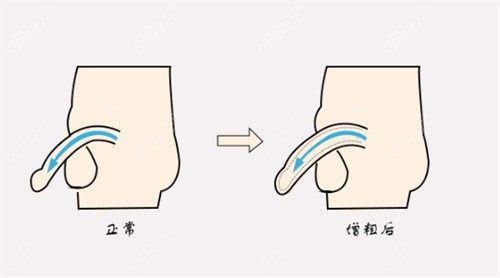 生物补片增粗【   】