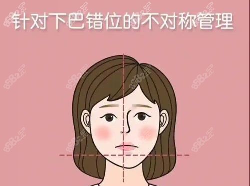 正颌手术.jpg