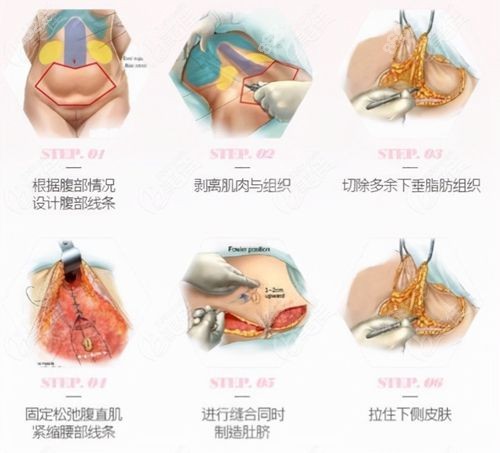 李献和腹壁成形失败例子没有