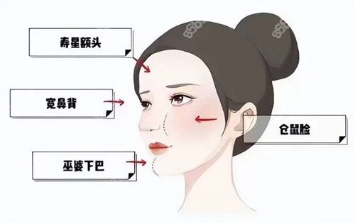 马梅生修复脂肪技术好,花3万多找他做脂肪馒化脸面吸很成功