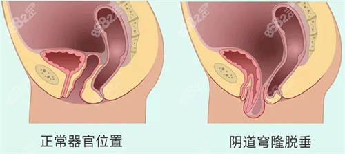 四、蝴蝶阴的优点