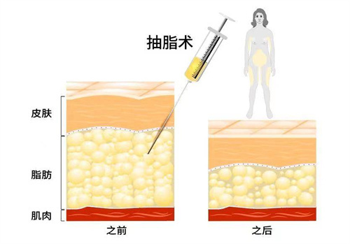 北京赵军舰吸脂技术好，不会凹凸不平，抽脂收费也不贵