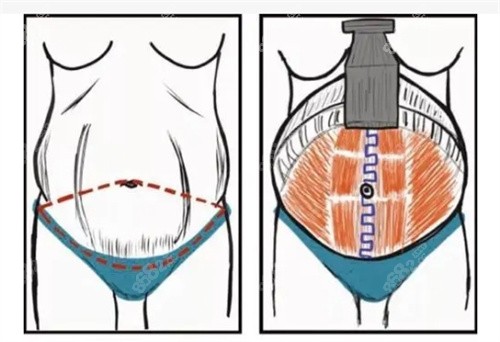 做腹壁整形需要多少费用