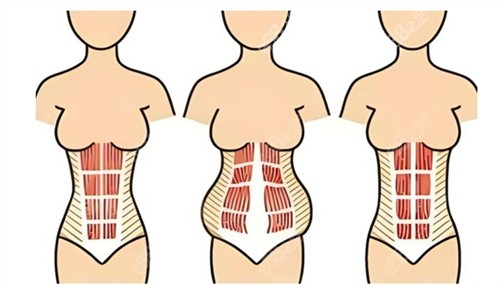 腹壁整形术【   】好的医院