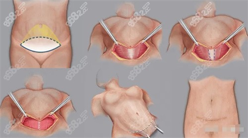 个人亲历腹壁整形术对身体伤害不大，一般3个月就可以复元