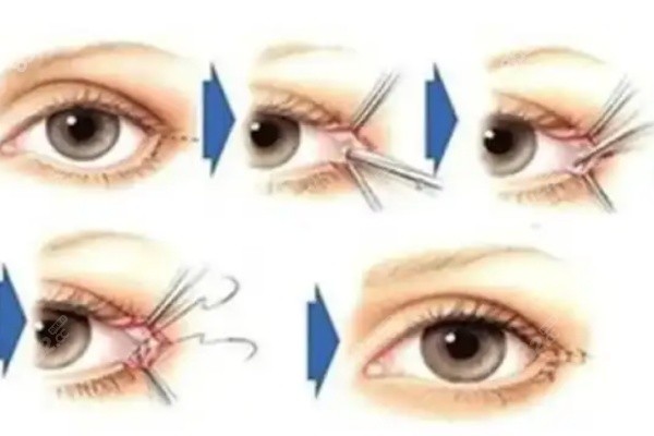 杜园园双眼皮修复技术怎么样