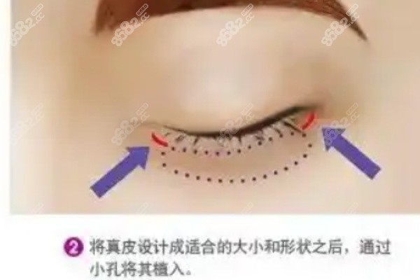 杜园园双眼皮修复后