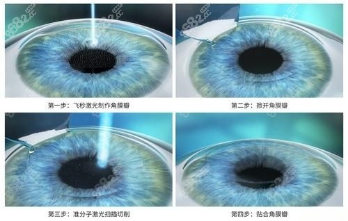 王燊医生全飞秒近视手术的技术扎实