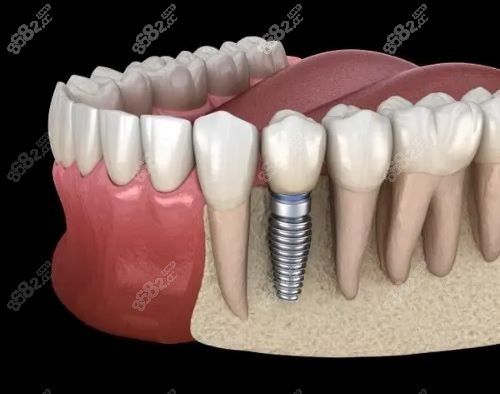 固原舒康口腔医院种植牙多少钱