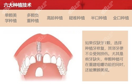 成都新桥口腔医院种植牙收费标准