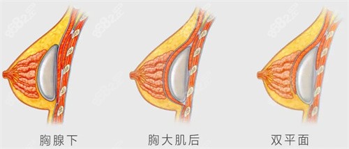 公布上海假体隆胸医生排名