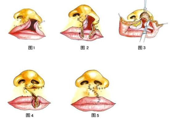 唇腭裂手术免费吗