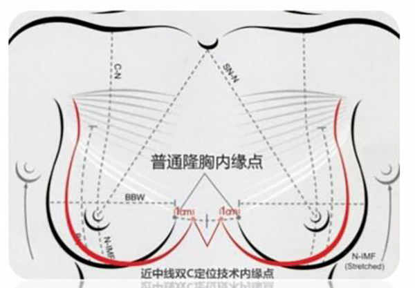 太值了！花8万找夏建军做曼托假体隆胸真实自然老公没发现