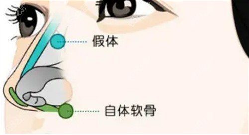 武漢玻尿酸打鼻子醫(yī)生