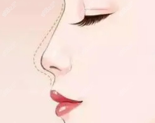 武漢玻尿酸打鼻子醫(yī)生口碑評價