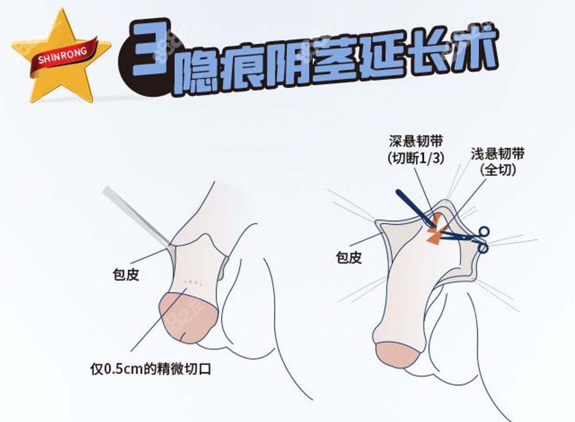 李世荣医生男科手术失败修复价格