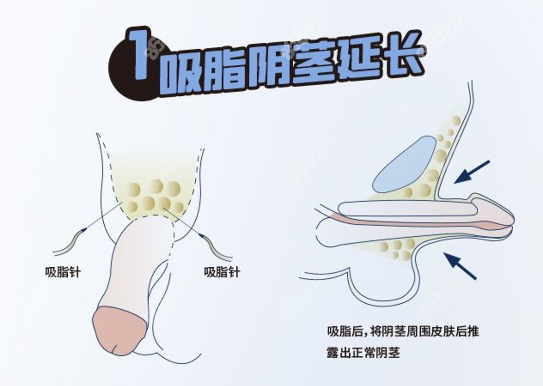 李世荣医生失败范例修复12.8w-男科增粗延长修复实例成效榜