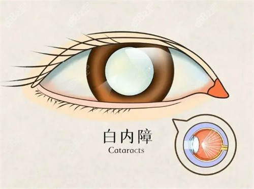 国内白内障手术费用