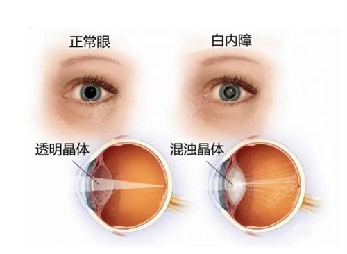 国内白内障手术费用