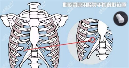 玻尿酸填充、肋软骨隆鼻、假体隆鼻哪个好？