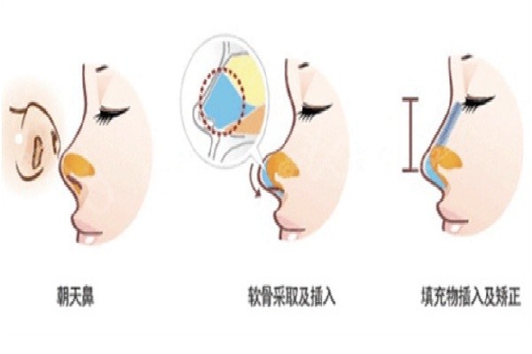 西安杨万忠鼻子病例