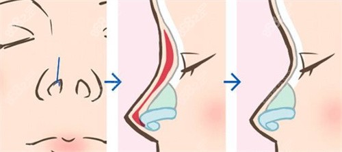 2、华美整形医院隆鼻手术的种类及特点