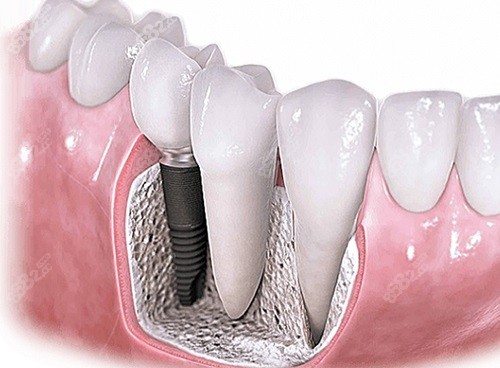 南充团圆口腔医院可以做种植牙吗？
