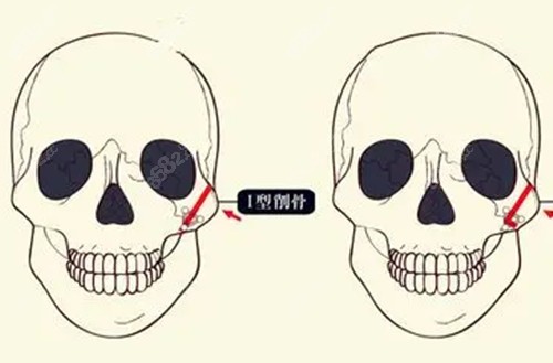 颧骨手术示意图