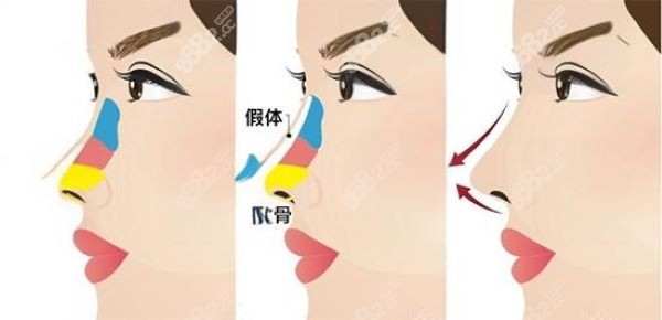 深圳张辉做鼻子术例