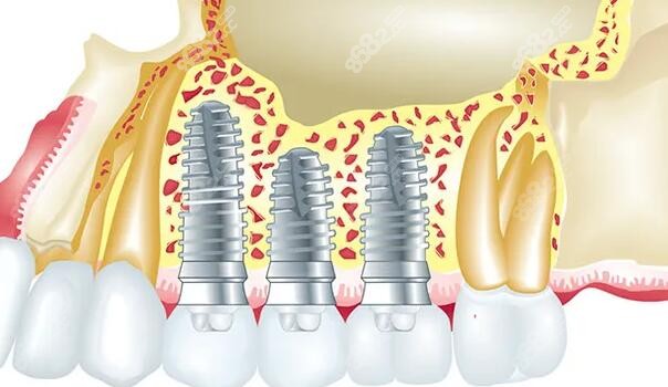 成都贝臣口腔850元种植牙是真的吗
