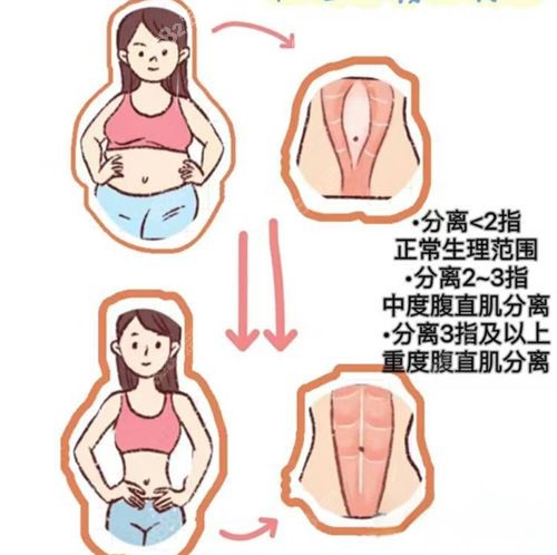 赵军舰吸脂成功实例展示