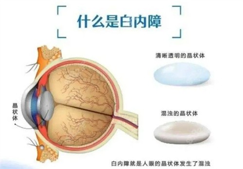 北京白内障手术免费政策2025新消息