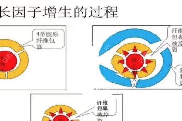 郭鑫取注射物生长因子水平如何