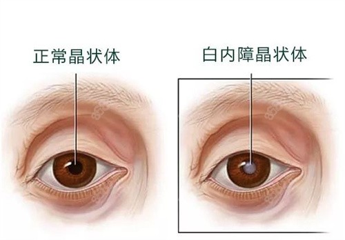 杭州白内障手术免费政策