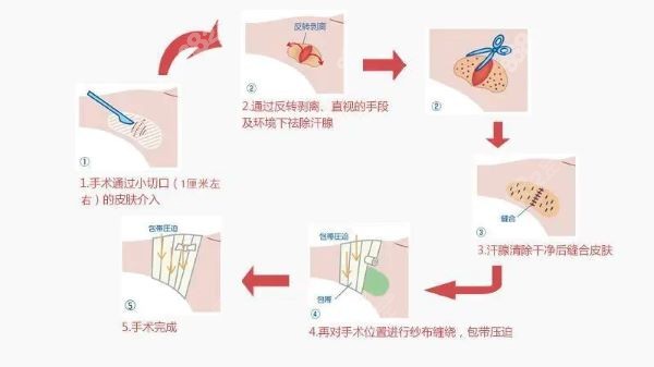 四川友谊医院腋臭科技术怎么样