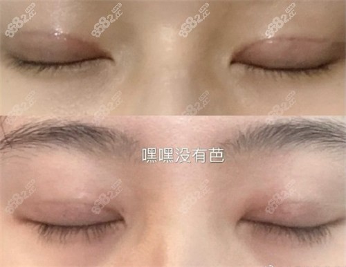 杜园园修复手术的实例分享