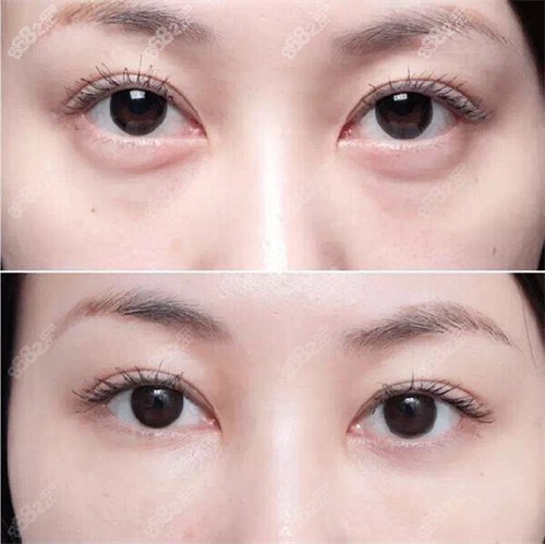 在整形美容的领域里，眼部整形及修复一直备受关注。“爱尚丽格杜园园做毁容眼睛吗？”“杜园园修复成功几率高吗？”“杜园园靠谱吗？” 这些问题频繁出现在百度搜索的词条中，反映出求美者们对眼部整形尤其是修复手术的高度谨慎与关切。接下来，我们将深入剖析爱尚丽格杜园园医生在眼部整形修复领域的专精表现，为大家揭开谜底。  杜园园是谁？为什么她的修复手术如此受欢迎？ 杜园园是爱尚丽格医疗美容机构的从业多年眼部整形骨干医生，专注于眼部整形及修复手术多年。她以其细腻的手术风格和独到的审美理念，在业内享有极高的声誉。许多求美者在初次手术失败后，都会选择杜园园进行修复。她的修复手术不仅成功几率高，还能根据每个人的眼部情况量身定制方案，确保术后成效自然、美观。  关于“爱尚丽格杜园园做毁容眼睛”的传闻，实际上是一些不实信息的传播。杜园园的手术实例中，绝大多数求美者都对术后成效表示满意。她的专精能力和职责心，让她成为许多人心目中的“眼部修复undefined人”。  杜园园修复手术的成功几率为什么高？ 丰富的临床经验  杜园园从事眼部整形及修复手术多年，积累了大量的临床经验。她熟悉各种眼部问题的处理方法，能够精细判断手术难点，并制定出非常适合的修复方案。  精细的手术技术  眼部修复手术对医生的技术要求极高，而杜园园以其细腻的手术风格著称。她在手术中注重细节，力求将创伤降到较低，同时确保术后成效自然、协调。  个性化设计方案  每个人的眼部情况不同，杜园园在手术前会与求美者充分沟通，了解他们的需求和期望，然后结合自身的专精判断，制定出个性化的手术方案。  精良的设备和技术  爱尚丽格医疗美容机构配备了国内外领跑的医疗设备，为杜园园的手术提供了强有力的技术支持。同时，她也不断学习国内外前列的整形技术，确保自己的技术水平始终处于行业前列。  杜园园修复手术的实例分享 实例一：双眼皮修复 一位求美者在其他机构进行双眼皮手术后，出现了不对称、疤痕明显等问题。经过杜园园的修复手术，她的双眼皮线条变得流畅自然，疤痕也得到了明显改善。术后，她对成效非常满意，并表示杜园园的手术让她重拾自信。  实例二：眼袋修复 另一位求美者在眼袋手术后出现了下睑外翻的问题，导致眼睛闭合不全，重度影响外观和功能。杜园园通过精细的修复手术，不仅解决了外翻问题，还让她的眼部轮廓更加年轻化。  为什么选择杜园园进行眼部修复？ 专精性强  杜园园专注于眼部整形及修复领域，拥有深厚的专精知识和丰富的临床经验。她的手术风格细腻，注重细节，能够为求美者提供高质量的修复服务。  成功几率高  杜园园的修复手术成功几率在业内名列前茅。她能够精细判断手术难点，并制定出非常适合的修复方案，确保术后成效自然、美观。  口碑好  许多求美者在杜园园的修复手术后，都对成效表示满意，并推荐给身边的朋友。她的专精能力和职责心，让她成为许多人心目中的“眼部修复undefined人”。  服务贴心  杜园园在手术前会与求美者充分沟通，了解他们的需求和期望，然后结合自身的专精判断，制定出个性化的手术方案。术后，她还会定期跟进修复情况，确保求美者的满意度。  关于“爱尚丽格杜园园做毁容眼睛”的真相 网络上关于“爱尚丽格杜园园做毁容眼睛”的传闻，实际上是一些不实信息的传播。杜园园的手术实例中，绝大多数求美者都对术后成效表示满意。她的专精能力和职责心，让她成为许多人心目中的“眼部修复undefined人”。  如果你正在寻找一位靠谱的眼部修复骨干医生，杜园园无疑是一个值得信赖的选择。她的修复手术成功几率高，成效显著，能够帮助你重拾美丽与自信。  如何预约杜园园的修复手术？ 如果你对杜园园的修复手术感兴趣，可以通过以下方式预约：  访问爱尚丽格医疗美容机构的法定网站，填写预约表单。  拨打爱尚丽格的客服热线，询问相关事宜。  前往爱尚丽格的线下门店，与专精顾问面对面沟通。  综上所述，“爱尚丽格杜园园做毁容眼睛吗？” 答案是否定的。杜园园医生凭借精良的技术、个性化的方案制定、丰富的临床经验以及良好的口碑，在眼整形修复领域取得了极高的成功几率，是一位值得信赖的靠谱医生。如果你正面临眼部整形失败的困扰，不妨考虑询问爱尚丽格的杜园园医生，她将用专精的技术为你重塑美丽与自信。  