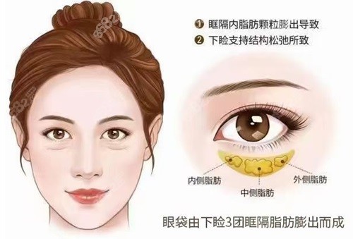 上海美诗沁宣瑞军超微创不开刀去眼袋