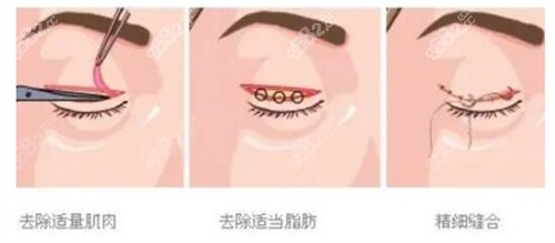 （四）完善的术后护理