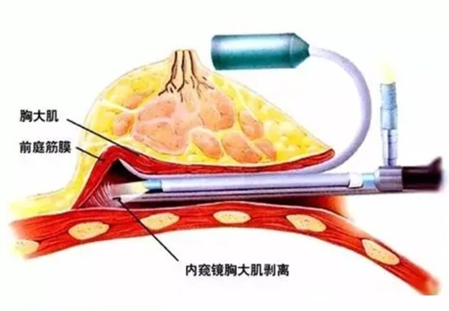 {上海殷初阳隆胸失败修复实例}殷初阳隆胸修复术后圆润挺拔