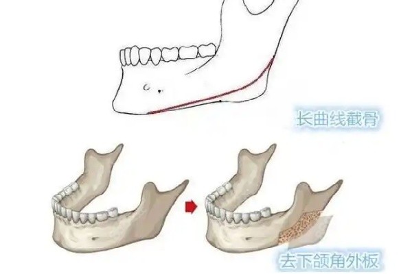 何照华医生磨骨