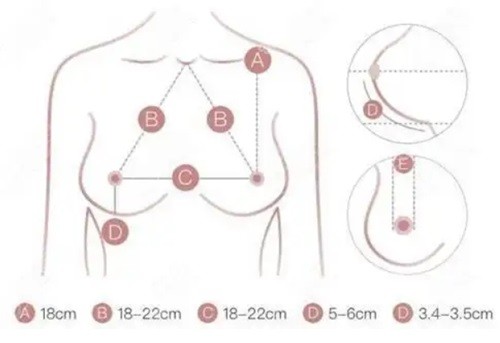 上海殷初阳隆胸失败修复实例