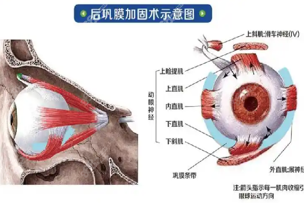 王乐今做后巩膜加固术是兜带式吗