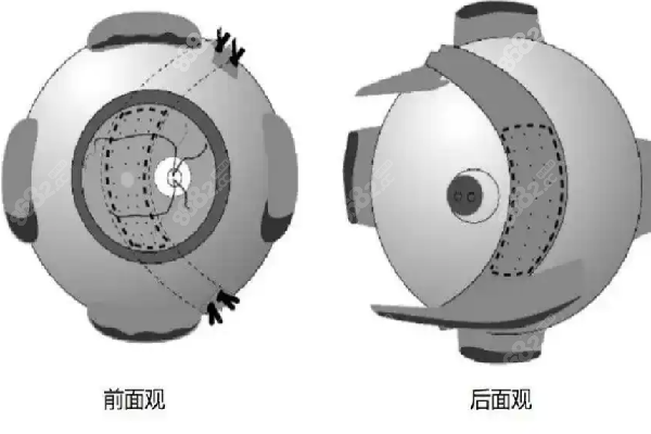 王乐今做后巩膜加固术费用多少